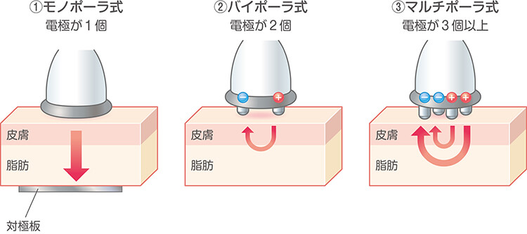 ラジオ波とハイパーナイフの違いは？機能、効果、その他ラジオ波機器と  