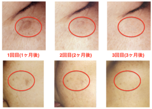ピグメンテーションデトックスの効果・口コミまとめ - 【公式】業務用  