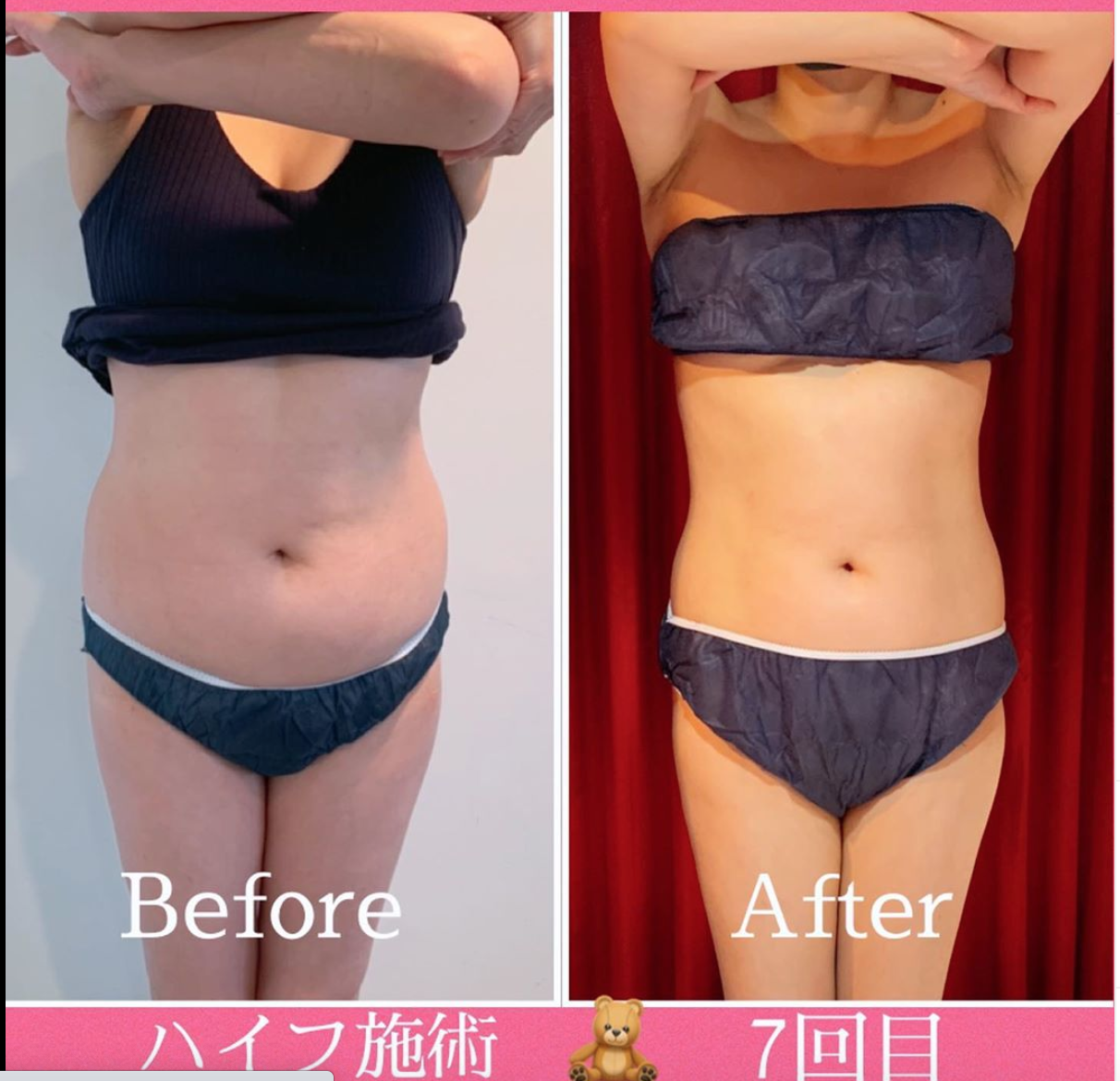 セルスイーパー エンダモロジー ダイエット 脂肪吸引 エステ