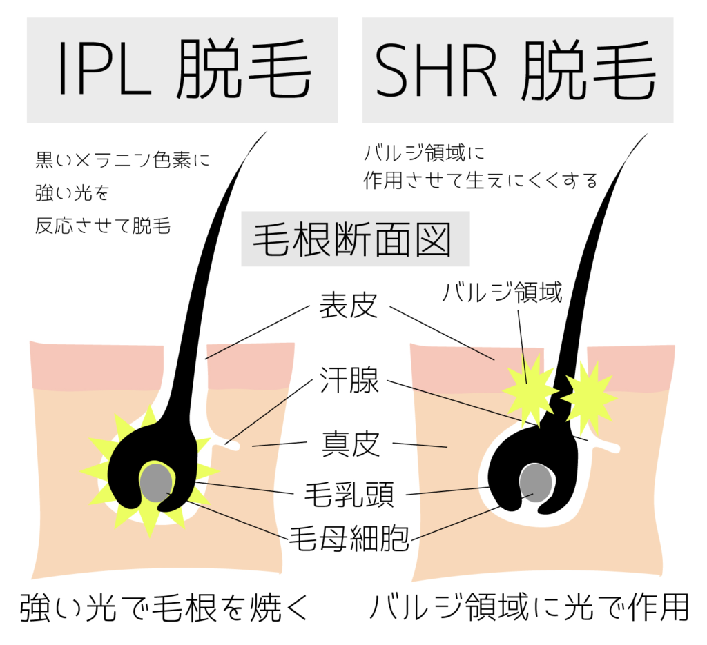 エステ サロン 業務用 SHR IPL 光 高速連射 脱毛器