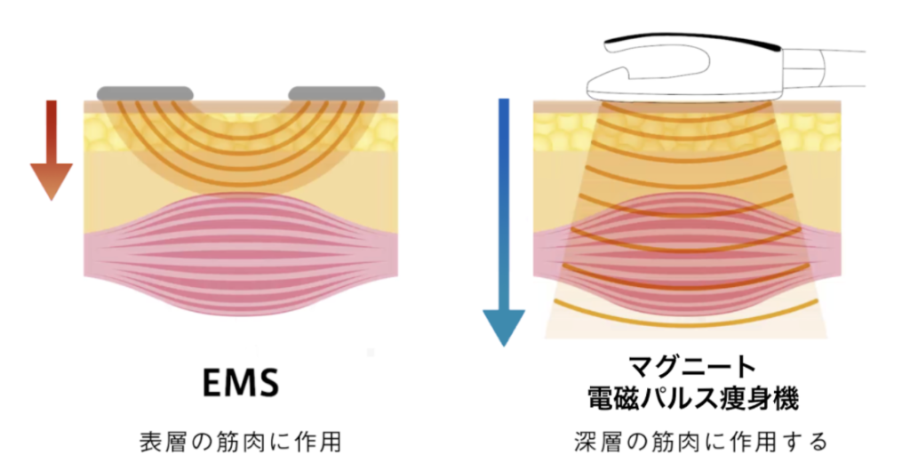 電磁パルス痩身機マグニートとは？価格や特徴、EMSとの違いについて 