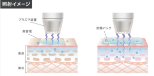 busome plasma 美顔器　プラズマ 業務用プラズマ美顔器シミプラズマプロの特徴、効果、サポートを徹底