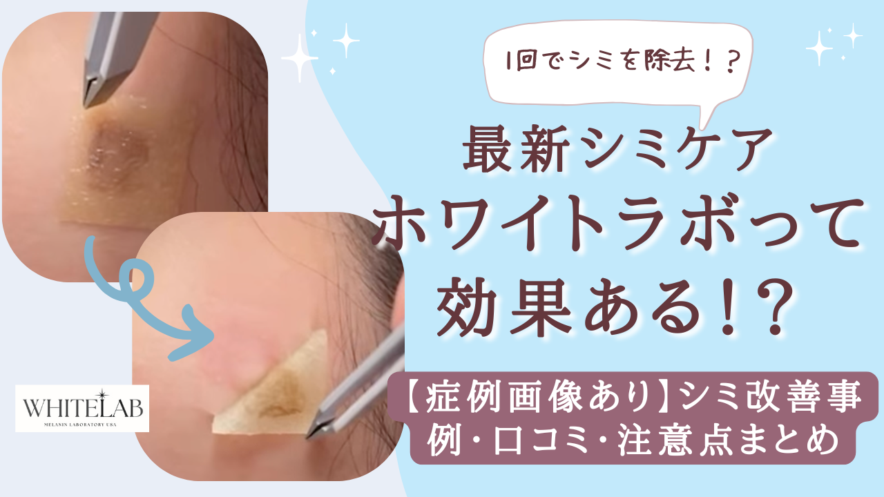 ホワイトラボのシミ取りって効果ある！？【症例画像あり】効果のある 